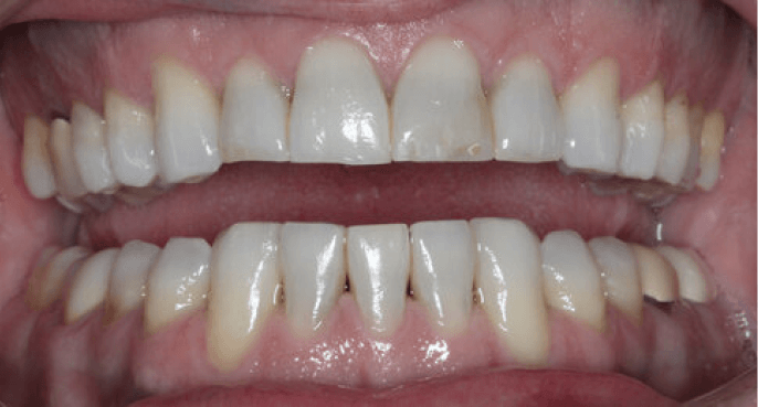 3D-image-of-a-single-implant-in-lower-jawbone 2 (1)