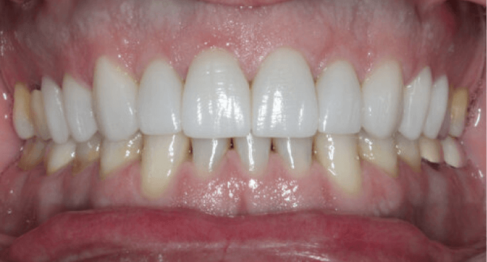 crown-dental-bridge-image 1 (1)